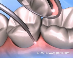 LANAP Laser treatment for periodontal disease eliminates cutting and stitches