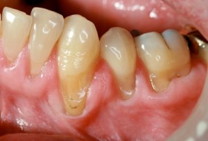 severe gum recession