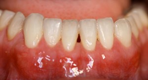 after connective tissue by Dr. Love