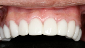 Periodontal Procedures After